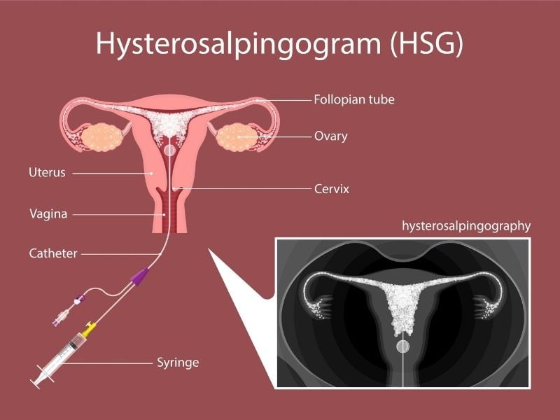 hsg chart of uterus hysterosalpingogram
