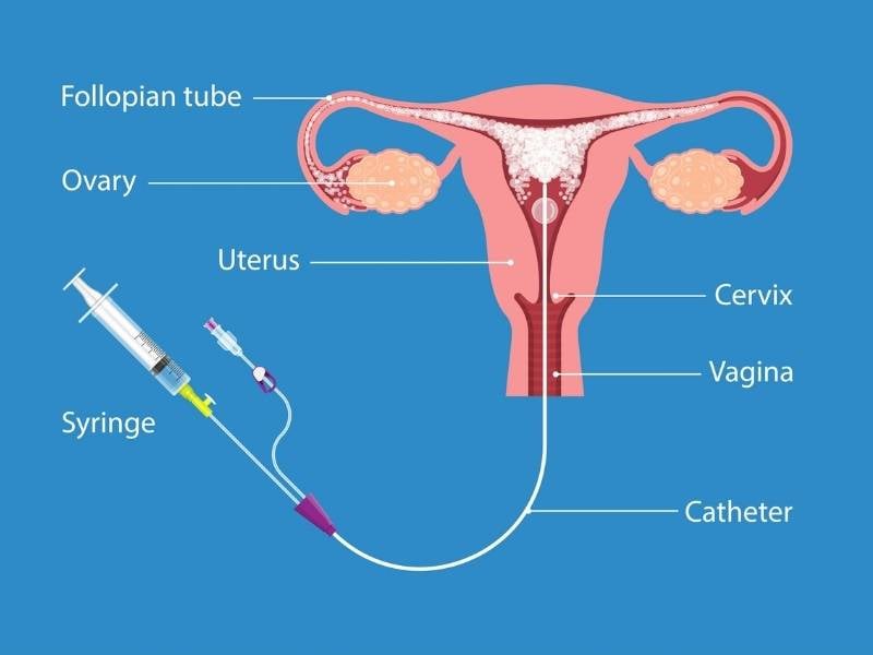 hysterosalpingogram hsg test uterus procedure diagram