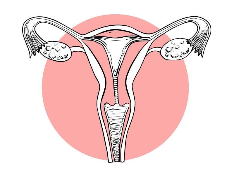 ovarian hyperstimulation ohss prvention