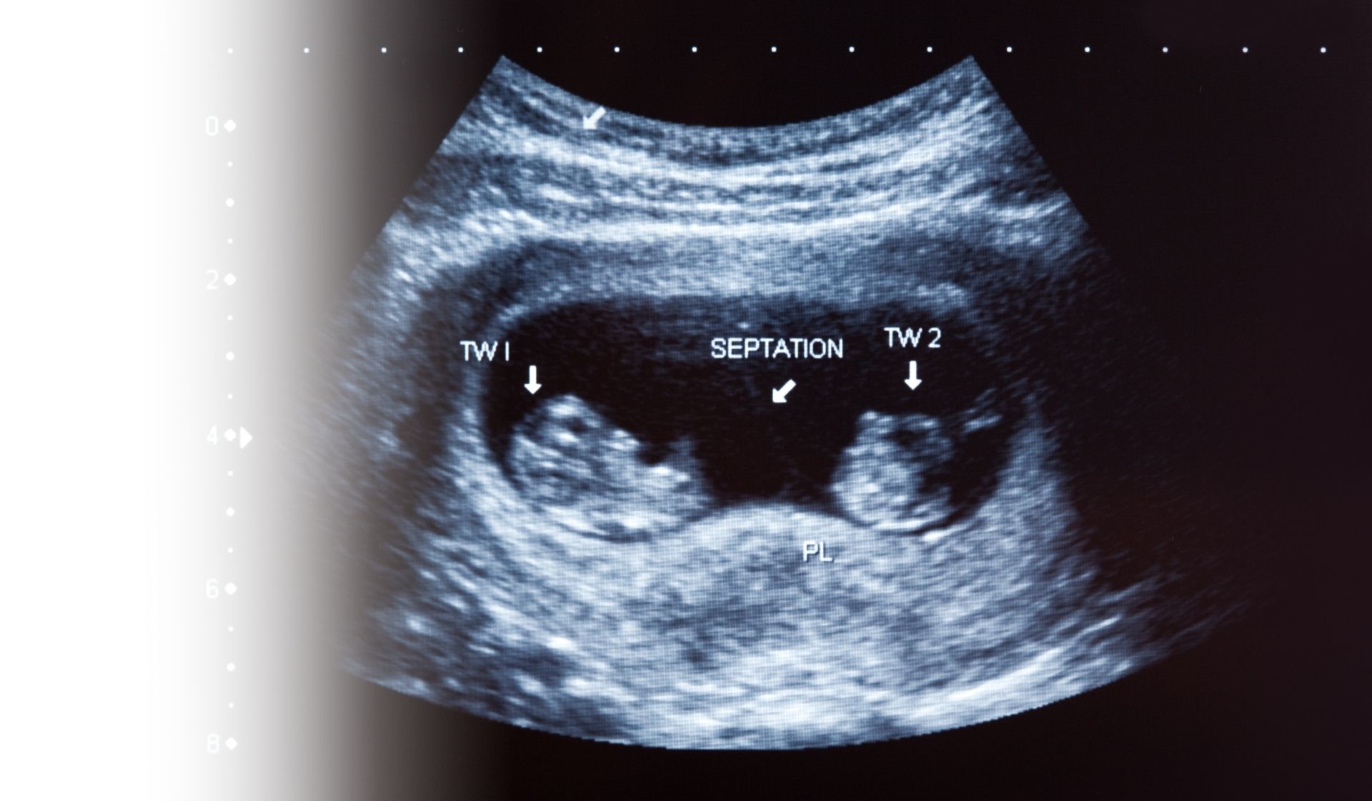 ivf twins risk single embryo transfer