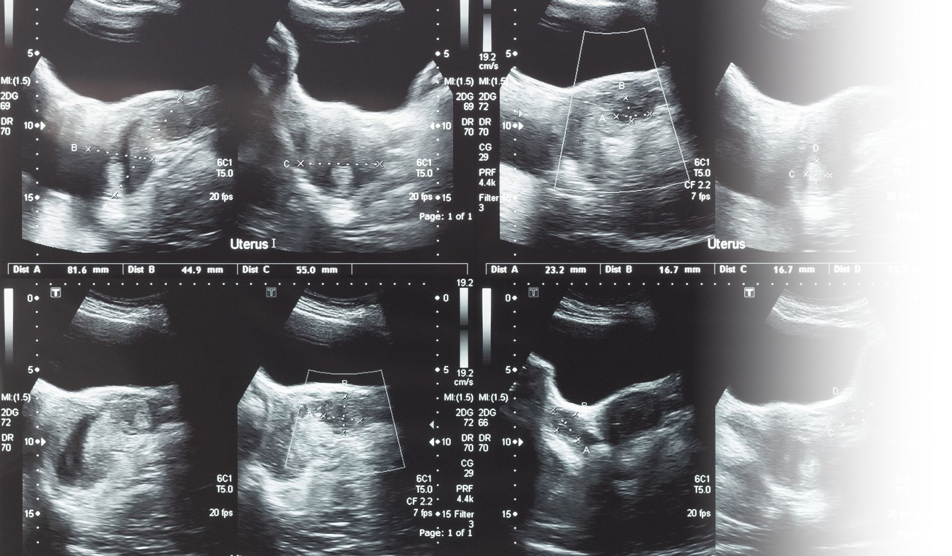 fertility testing uterus ovary fibroids follicles