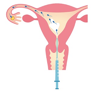 iui intrauterine insemination fertility procedure