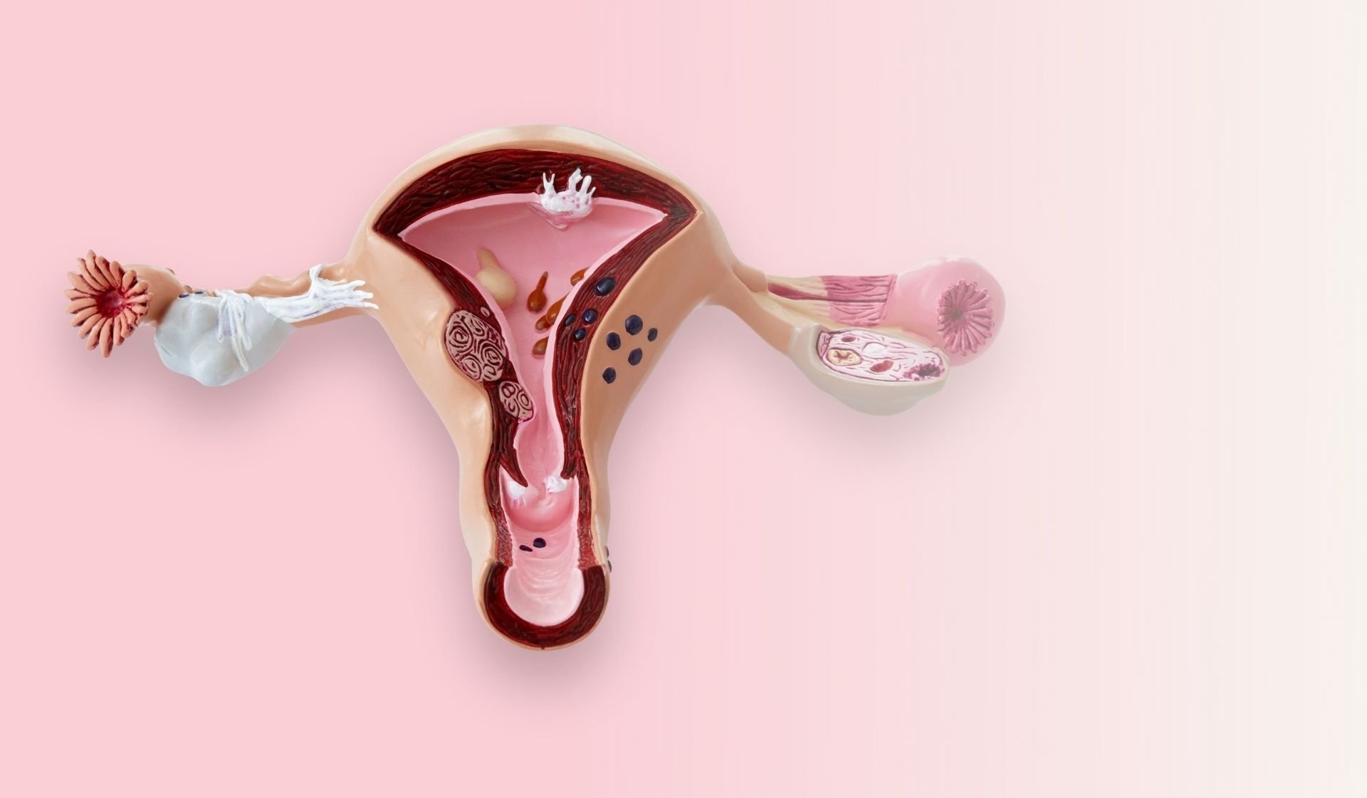 infertility tubal disease uterus