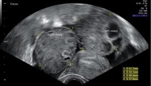 ovarian hyper stimulation ohss ultrasound