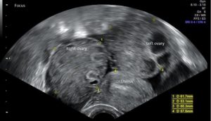  hyper stimulation ovarienne échographie ohss 