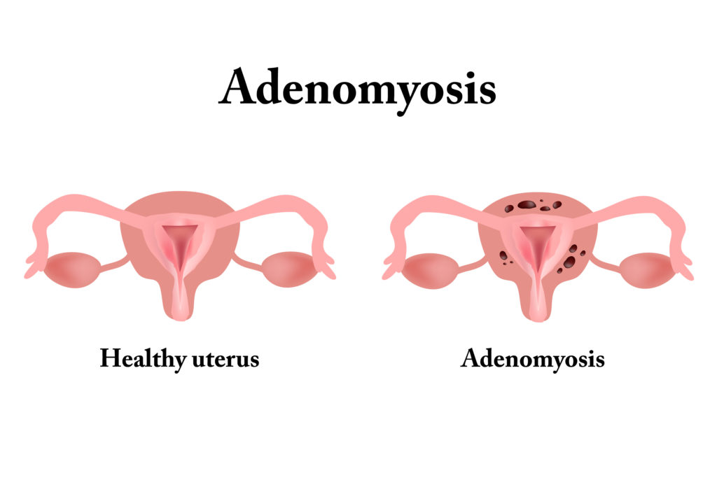 Adenomyosis Adenomyosis: The
