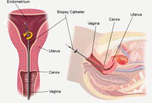 Endometrial Biopsy for Infertility Testing: How it works