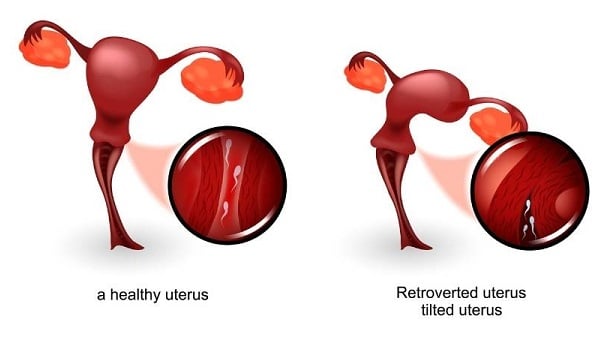 retroverted uterus (tilted) comparison diagram