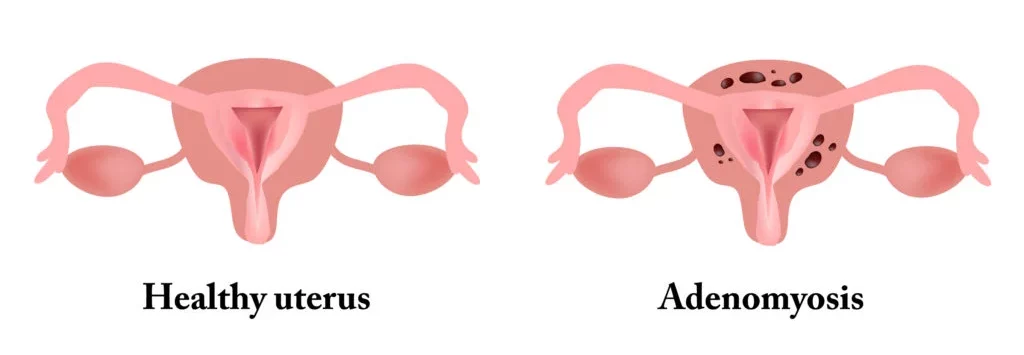 normal vs Adenomyosis uterus