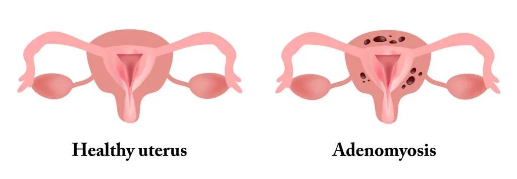 Adenomyosis Vs Endometriosis 5 Surprising Insights RMA Adenomyosis Vs Endometriosis 5 Surprising Insights RMA